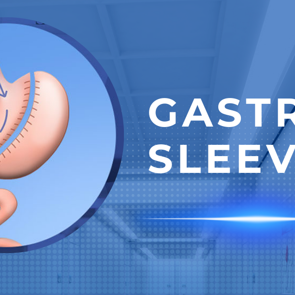 Gastric Sleeve