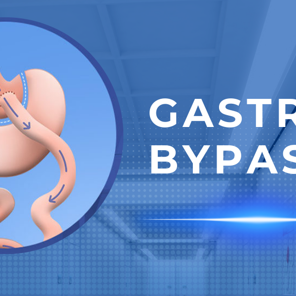 Gastric By-pass