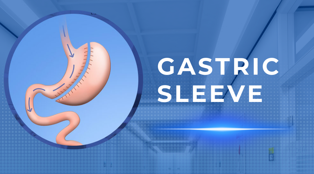 Gastric Sleeve