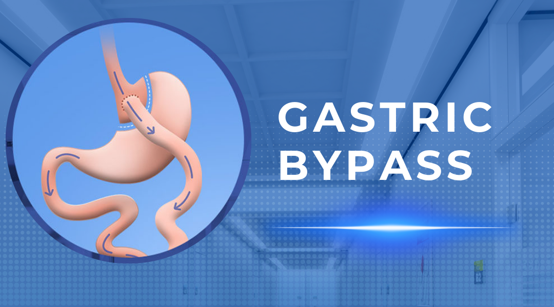 Gastric Bypass