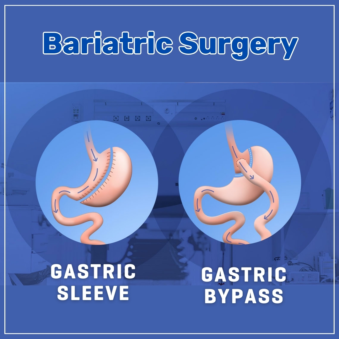 Bariatric Surgery