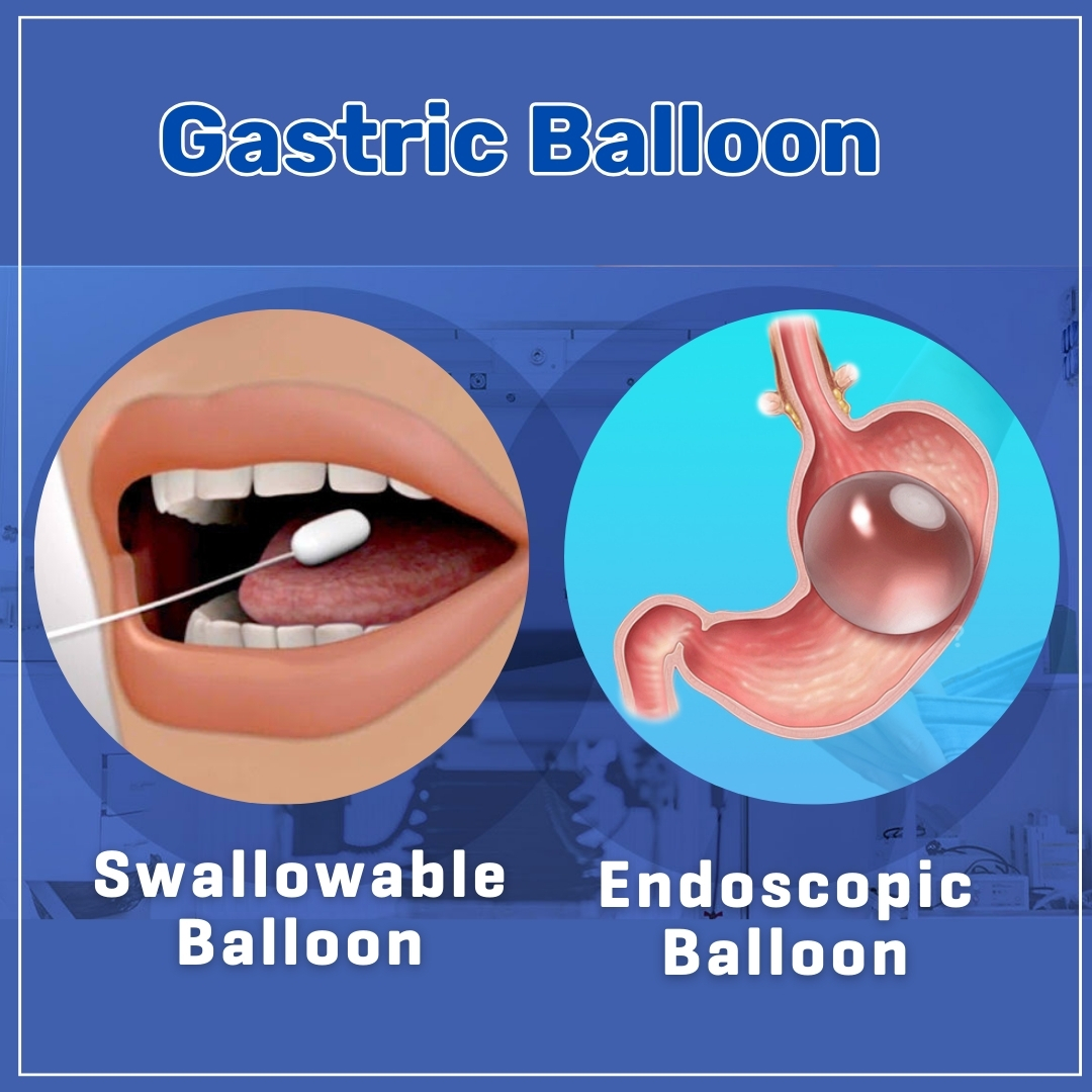 Gastric Balloon & Botox